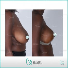 Breast lift Before & After Photos in Estetik International
