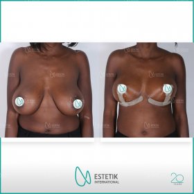 Breast lift Before & After Photos in Estetik International
