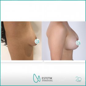 Breast augmentation Before & After Photos in Estetik International