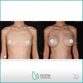 Breast augmentation Before & After Photos in Estetik International