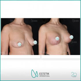 Breast Lift with Implants - Round Before & After Photos in Estetik International