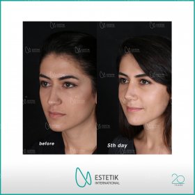 Rhinoplasty (nose job) Before & After Photos in Estetik International