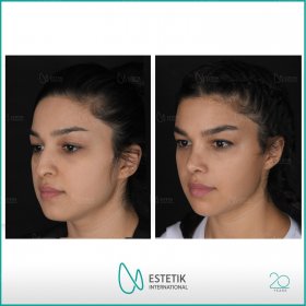 Rhinoplasty (nose job) Before & After Photos in Estetik International