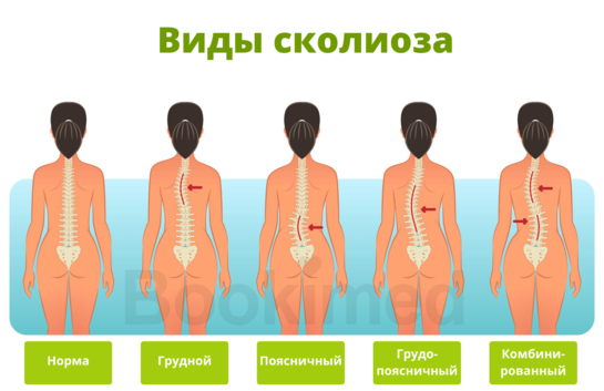 Сколиоз Сколиоз