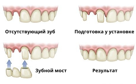 Implants all on 4 Импланты все на 4