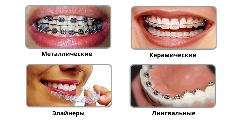 braces Брекеты