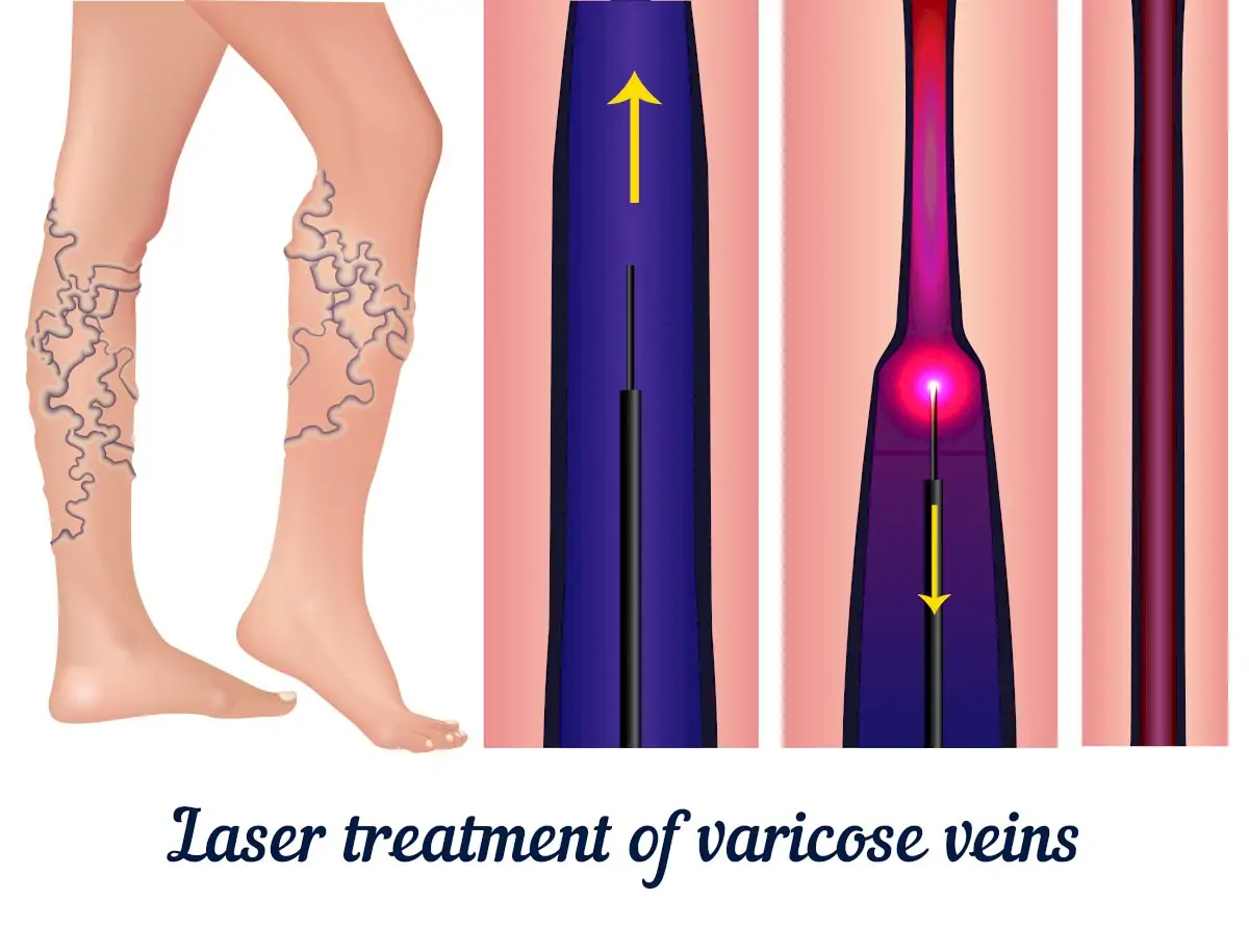 Vein Clinic Alanya