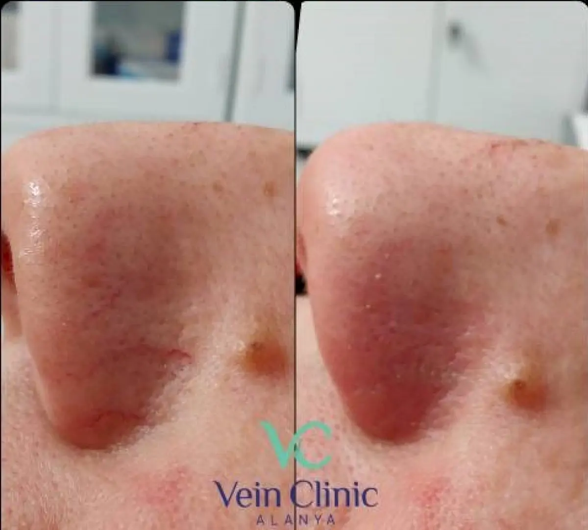 Vein Clinic Alanya