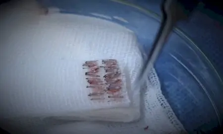 Injertos capilares preparados para trasplante en Emphair Hair Transplant Clinic