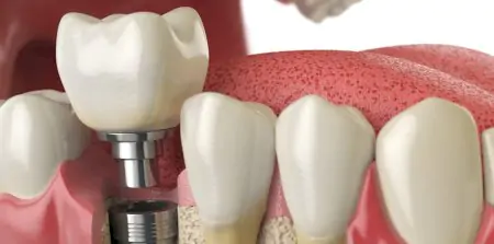 رسم توضيحي لزراعة الأسنان في FIZYOMER DENTA DENTAL CLINIC