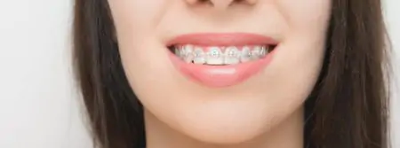صورة مقربة لتقويم الأسنان على مريض في FIZYOMER DENTA DENTAL CLINIC