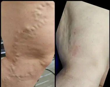 قبل وبعد علاج الدوالي في Vein Clinic Alanya Antalya