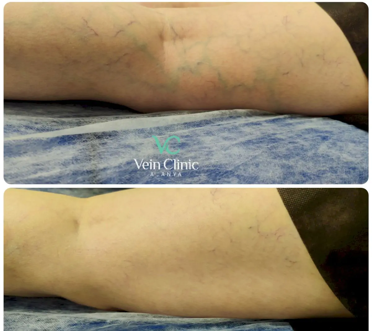 Vein Clinic Alanya