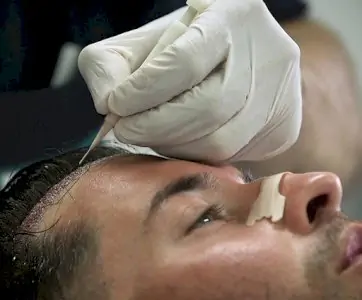 إجراء زراعة الشعر في عيادة Seneca Hair Restoration أثينا