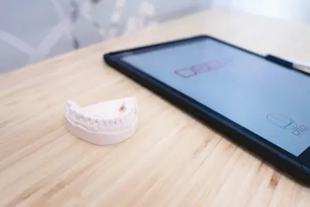 قالب أسنان وجهاز لوحي رقمي في Best Dent Clinic لتخطيط العلاج