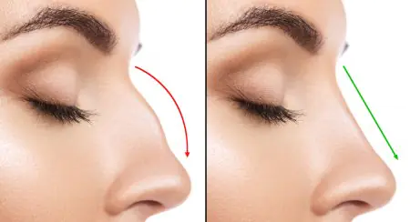 مقارنة جانبية للأنف قبل وبعد عملية تجميل الأنف مع خطوط تصحيح