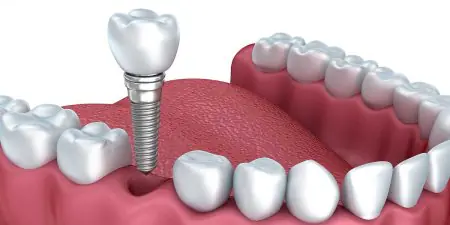 رسم توضيحي لزرع الأسنان لاستبدال السن في عيادة Dental Costa Rica