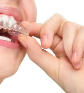مريض يضع تقويم أسنان شفاف في Sohal Dental Practice