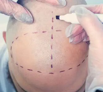 تخطيط إجراء زراعة الشعر في عيادة NextGen- Hair Transplants