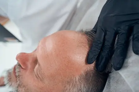 استشارة زراعة الشعر في عيادة NextGen- Hair Transplants