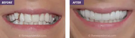 Antes y después de carillas dentales en Fiveways Dental Practice, mejora estética de la sonrisa