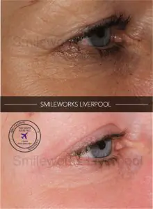 Antes y después del tratamiento de arrugas oculares en Smileworks Liverpool