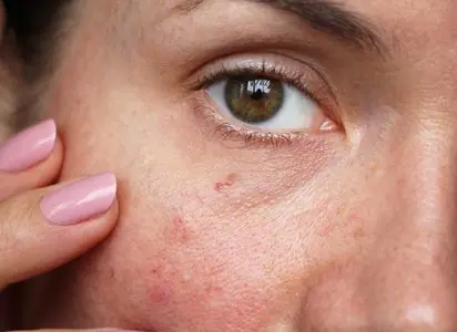 صورة مقربة لبشرة الوجه مع احمرار، رعاية جلدية في Dermal Clinic Edinburgh