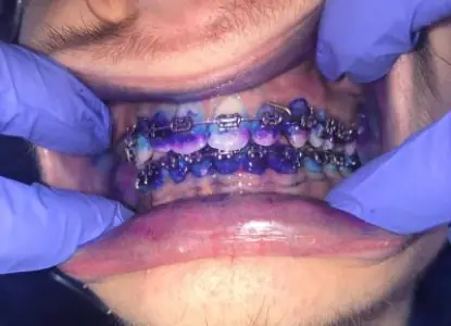 Ajuste de brackets dentales en Craigentinny Dental Care, Edimburgo