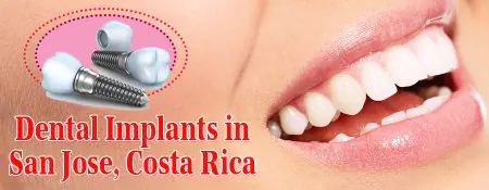 زرعات الأسنان وابتسامة مريض في Dental Implants Costa Rica، سان خوسيه