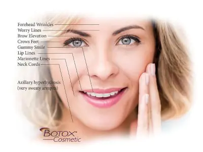 Áreas de tratamiento con botox para arrugas e hiperhidrosis en Steven K Struck MD