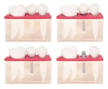 نموذج إجراء زراعة الأسنان في مركز Thantakit Dental فرع براتونام