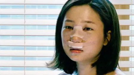 Paciente tras rinoplastia en Cosmetic Surgery Thailand con vendajes nasales
