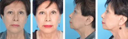 Resultados de lifting facial antes y después en Plastic Surgery Chicago