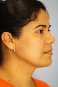 Perfil de paciente femenina antes de cirugía estética en Liposuction & Cosmetic Surgery Institute