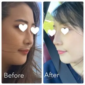 نتائج قبل وبعد عملية تجميل الأنف في عيادة Evolve Aesthetic Surgery