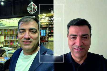 نتائج قبل وبعد زراعة الشعر في Bellus Clinic إسطنبول، تركيا
