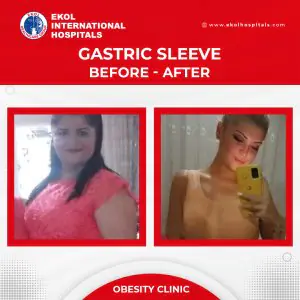 Resultados antes y después de manga gástrica en EKOL International Hospitals, Esmirna