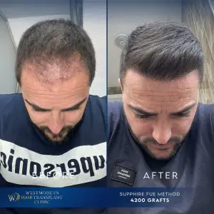 قبل وبعد زراعة الشعر في عيادة WestModern بطريقة Sapphire FUE، 4200 طعم