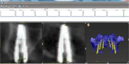 Software de planificación de implantes dentales en Warsaw Dental Academy, Polonia