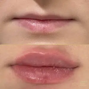 Antes y después de aumento de labios en Elizabeth Beauty Clinic
