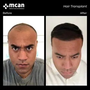نتائج زراعة الشعر قبل وبعد في MCAN Health، استعادة خط الشعر