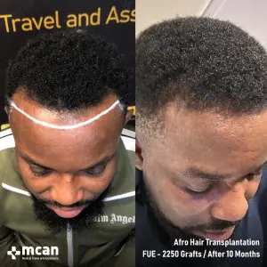 نتائج زراعة الشعر الأفريقي في MCAN Health إسطنبول، تقنية FUE 2250 طعماً، بعد 10 أشهر