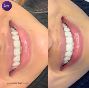 قبل وبعد عدسات الأسنان في Love Dental and Sthetic Clinic