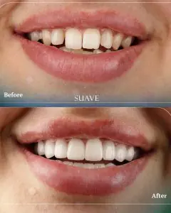 قبل وبعد عدسات الأسنان في SUAVE Dental Clinic، تحسين جمالية الابتسامة
