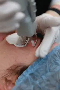 Tratamiento láser de la piel en Altos Clinic con equipo dermatológico avanzado