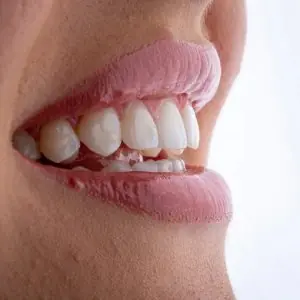 صورة مقربة لأسنان بيضاء صحية بعد علاج الأسنان في عيادة Atelier Uśmiechu