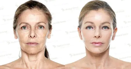 Resultados de lifting facial antes y después en JK Plastic Surgery Center