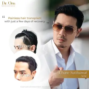 نتائج قبل وبعد زراعة الشعر في عيادة Dr.Orn، مركز الشعر الطبي