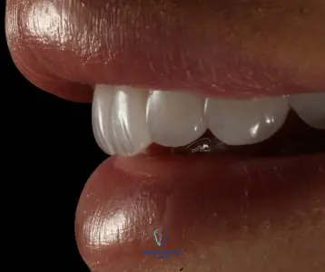 صورة مقربة لعدسات الأسنان في مستشفى Grand Dental Hospital