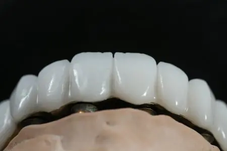 نموذج جسر زرع الأسنان في Grand Dental Hospital & Laboratory